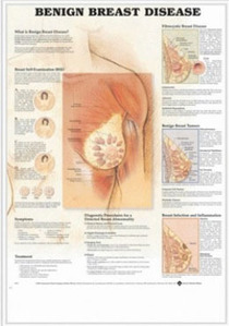 3D해부도(벽걸이)/  9759 /여성가슴질환 ( BENIGN BREAST DISEASE )