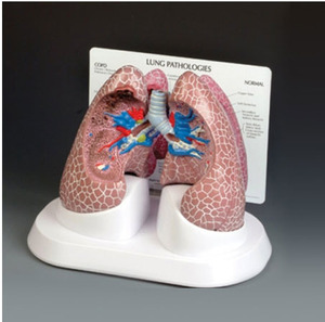 [GPI]폐질환모형/G311/Diseased Lung 311/폐모형,허파모형